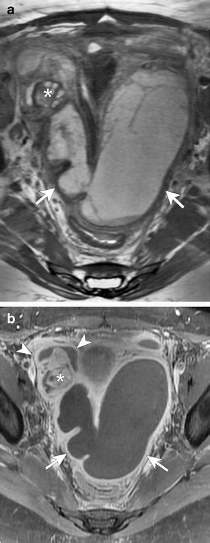 Tubo Ovarian Abscess With Pyosalpinx In A 13 Year Old Diabetic Girl Who Download Scientific