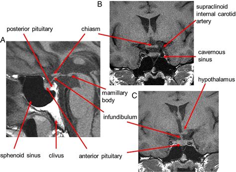 The Parasellar Region And Central Skull Base Practical Neurology