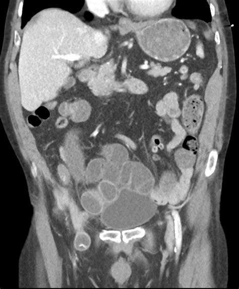 Small Bowel Obstruction Secondary To Femoral Hernia Image