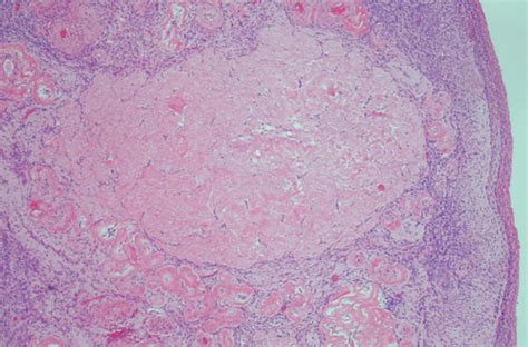 Ovary Stroma Histology