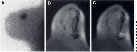 Figure From Comparison Of Technetium M Sestamibi Scintimammography