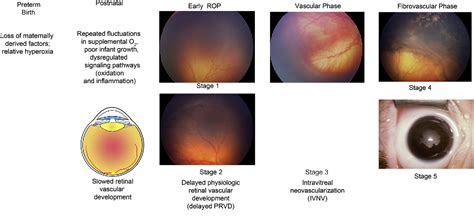 Figure 1 From Pathophysiology And Mechanisms Of Severe Retinopathy Of