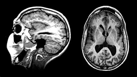 Polymicrogyria: Causes, Symptoms and Effects | 2024