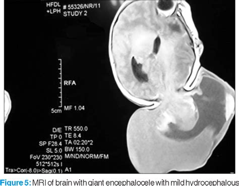 Figure From A Giant Occipital Encephalocele With Spontaneous