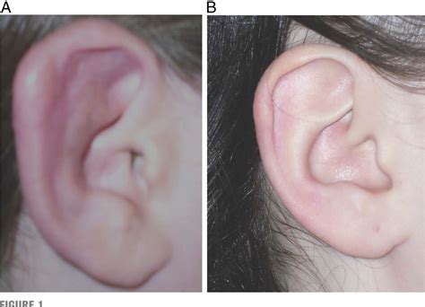 Figure 2 from Lyme Chondritis Presenting as Painless Ear Erythema ...