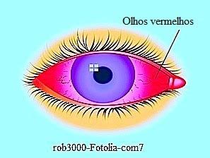 Olhos vermelhos causas sintomas e colírios