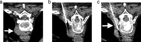 Image Guided Percutaneous Lung Needle Biopsy How We Do It Techniques In Vascular