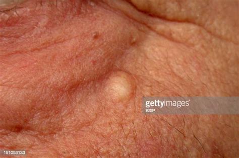 Sebaceous Cyst Photos Et Images De Collection Getty Images