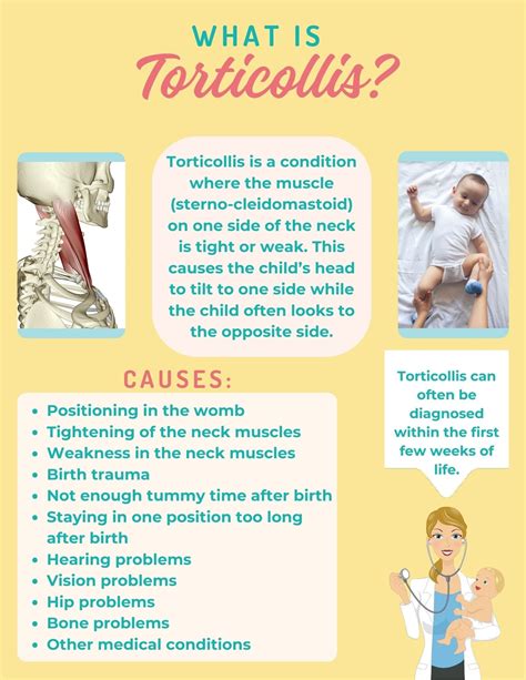 Torticollis Handout For Parents Caregivers Medical Etsy Uk