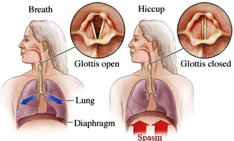 Hiccups - Causes, Learn How To Stop, Get Rid, and Prevent Hiccups