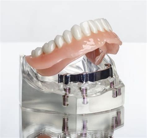 All-On-4 Implants | Implant Dentist in Laguna Hills, CA