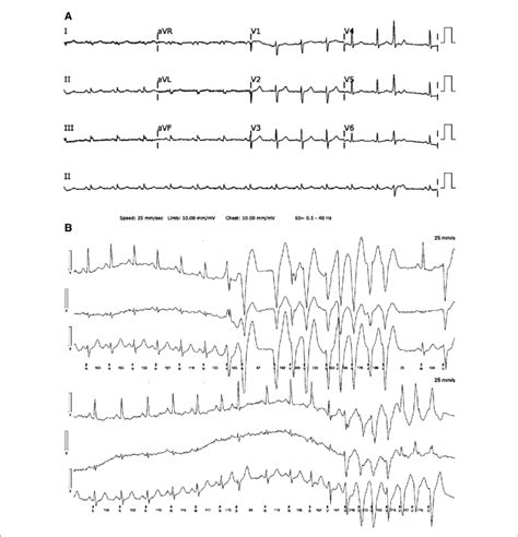 A A 12 Lead Electrocardiogram Reveals Low QRS Voltage In Limb Leads