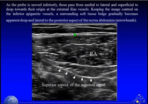 The Deep Inguinal Ring Is Lateral To Inferior Epigastric Vessels