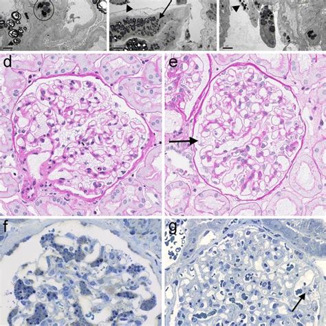 Some Of The Most Important Pathomechanisms In Fabry Nephropathy