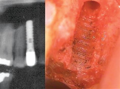 X Ray Image Of A Failed Implant Left Panel Titanium Corrosion In The