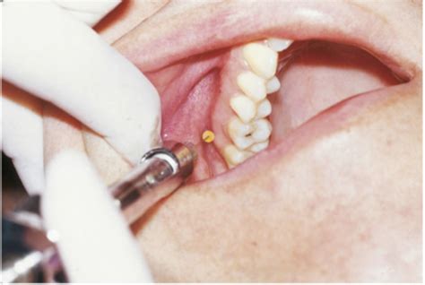 Chapter Anatomy Of Local Anesthesia Diagram Quizlet