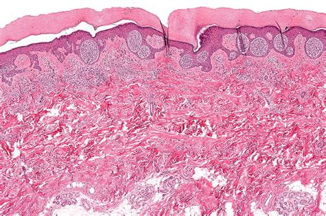 My Approach To Atypical Melanocytic Lesions Journal Of Clinical Pathology