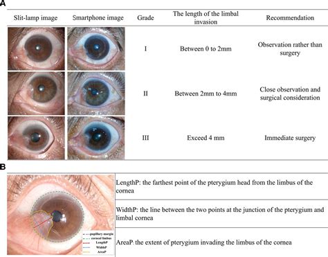 Accurate Detection And Grading Of Pterygium Through Smartphone By A