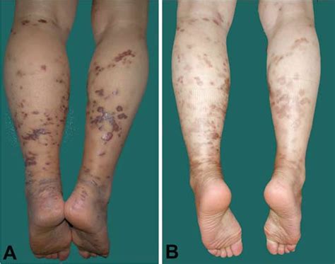 Figure 1 From Clearance Of Recurrent Classical Kaposis Sarcoma Using