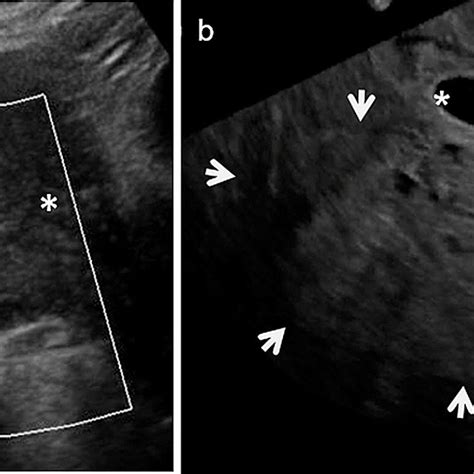 A 36 Year Old Woman With Cervical Ep Longitudinal Ultrasound Image Of Download Scientific