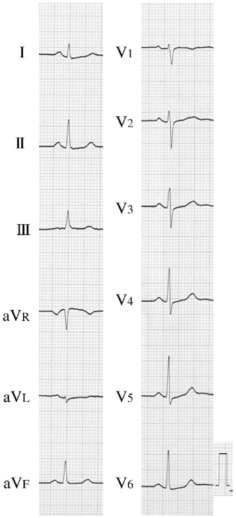 Leads Ecg Showed Sinus Rhythm Heart Rate Beats Min And P Wave