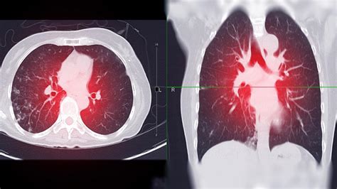 Tromboembolismo pulmonar qué es qué síntomas tiene y cómo se puede tratar