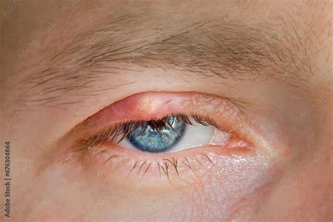 Chalazion Slow Growing Lump Or Cyst That Develops Within The Eyelid Burst Abscess Inflamed