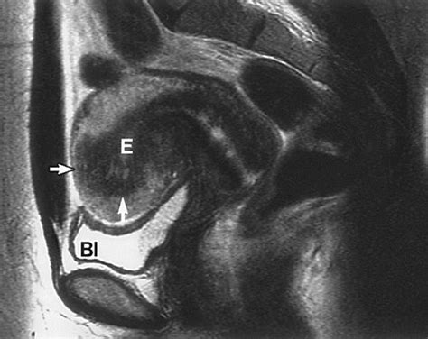 Uterine Adenomyosis Endovaginal Us And Mr Imaging Features With