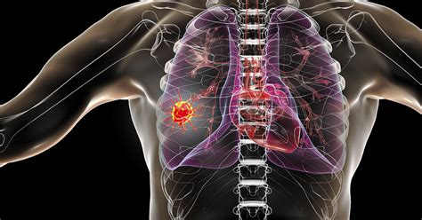 Urge Congress To Take Action Against Lung Cancer And Support Womens