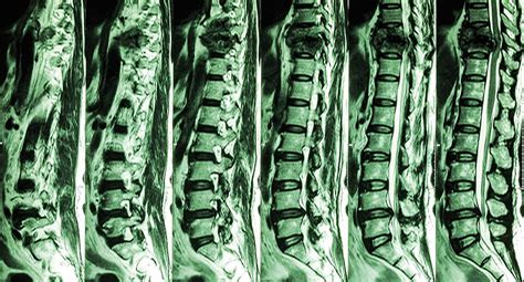 Fractured Thoracic Spine And Spinal Cord Compression Seen On Mri Photo