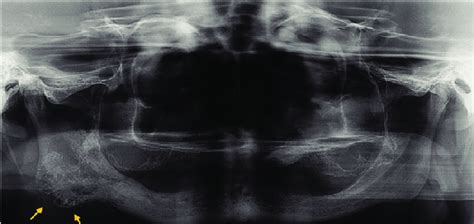 Panoramic Radiography Showing A Multilocular Osteolytic Radiolucency At