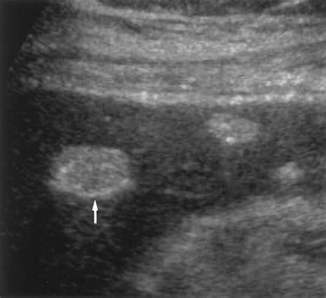 Fat Containing Lesions Of The Liver Radiologic Pathologic Correlation