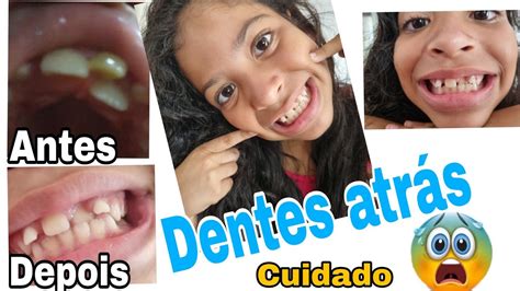 Dentes permanentes da criança nascendo ATRÁS do dente de leite CUIDADO