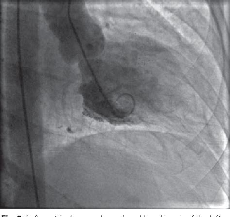 Figure 1 From Reverse Takotsubo Cardiomyopathy After An Episode Of