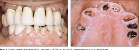 Figure 2 from Karies hos äldre | Semantic Scholar