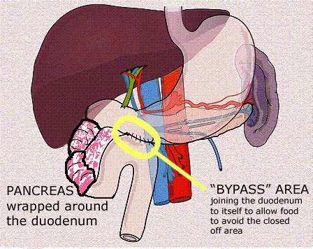 Duodeno-duodenostomy | I tried to draw in the annular pancre… | Flickr