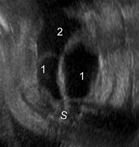 Airp Best Cases In Radiologic Pathologic Correlation Prenatal And Postmortem Imaging Of A