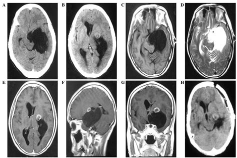 Malignant Transformation Of An Epidermoid Cyst In The Temporal And