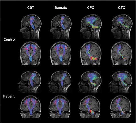 Somatosensory Motor Tracts In A Representative Control And Ataxia