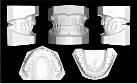 Class Ii Malocclusion With Severe Overjet Treated With Maxillary Second