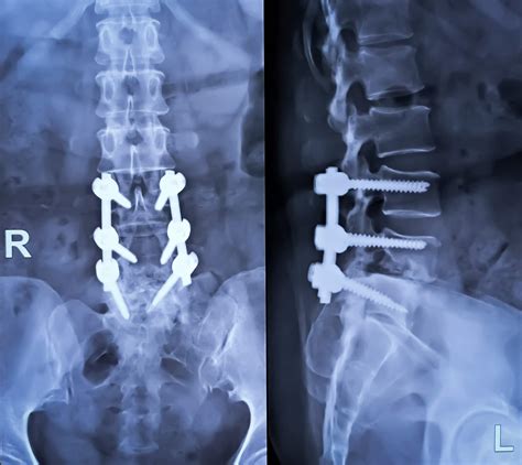 What to Expect from Your Lumbar Fusion Surgery