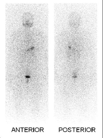 Whole Body Iodine Scan For Routine Followup Mo After Ablation No