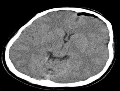 Unilateral pneumocephalus (CT scan, axial section, brain window). | Download Scientific Diagram