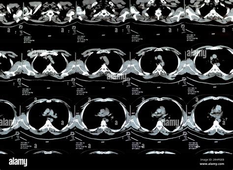 Multi Slice CT Scan Of The Chest Showing Normal Study Normal