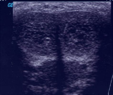 Transverse Grayscale Ultrasound Of Patient With Corporal Fibrosis