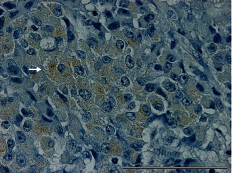 Tumor Cells With Acth Positivity Are Diffusely Present Arrow Shows A