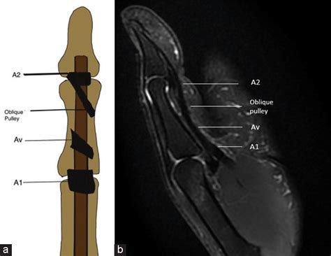 A1 Pulley Finger Mri At Michael Hammons Blog