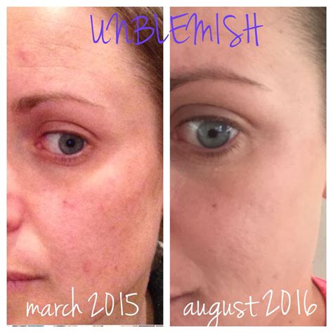 Got Acne Try Rodan Fields Unblemish Regimen To Get Rid Of This Pesky