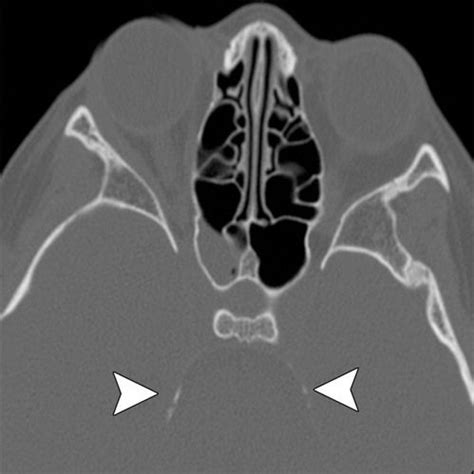 Periapical Lucency around the Tooth: Radiologic Evaluation and ...