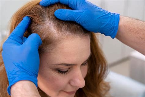 Hair Transplant For Women In Usa Cost And Procedure Css Philadelphia ️